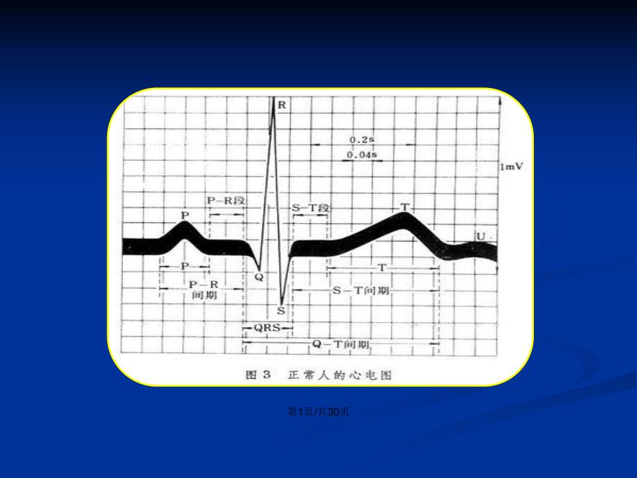 左室高电压与肥厚培训.pptx_第2页