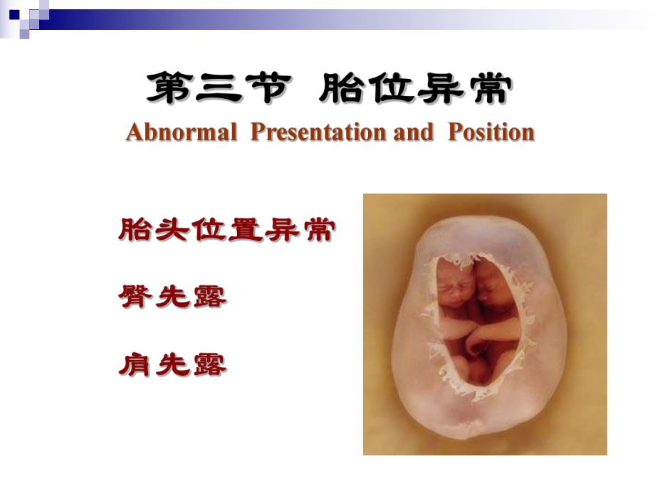 胎位异常教案PPT.ppt_第1页
